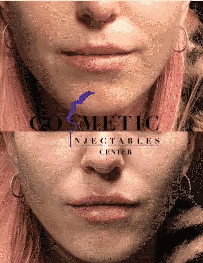 Close-Up Before And After Comparison Of A Cosmetic Lip Treatment, Displaying Enhanced Fullness And Shape At A Cosmetic Injectables Center