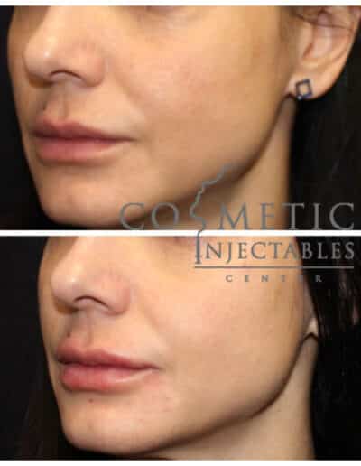 Side Profile Before And After Cosmetic Procedure, Highlighting Facial Contouring At A Cosmetic Injectables Center