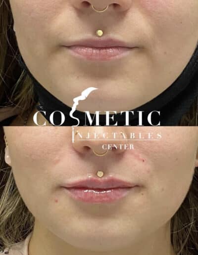 Before And After Comparison Of A Cosmetic Treatment Around The Mouth Area At A Cosmetic Injectables Center