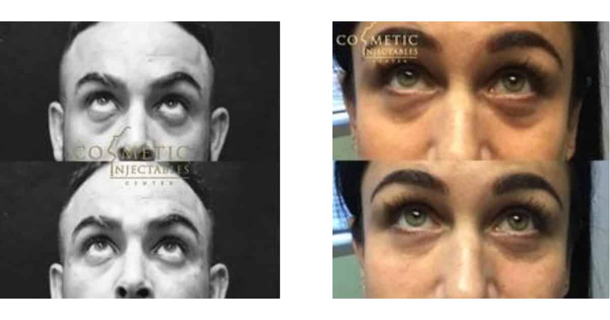 Before-And-After Of Under-Eye Injectables For A Male And Female, Showing Reduced Dark Circles And Bags.