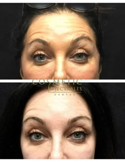 Dark-Haired Woman Showcasing Before And After Effects Of Forehead And Frown Line Reduction Treatment