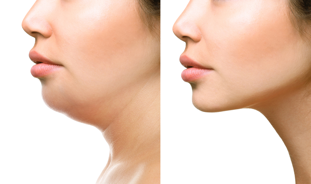 Profile Comparison Of Double Chin Reduction Showing Noticeable Decrease In Excess Fat Under The Jawline After Treatment.