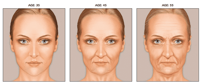 Facial Aging Progression At 35, 45, And 55 Illustrating Loss Of Facial Fat And Skin Elasticity