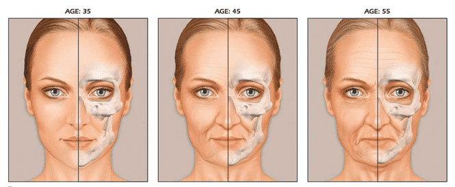Comparative Facial Aging At 35, 45, 55 Highlighting Bone Density Loss And Structural Changes