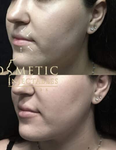 Side Profile Before And After Facial Contouring With Guide Marks At A Cosmetic Injectables Center