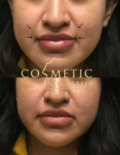 Before And After Facial Cosmetic Treatment With Planning Marks, Illustrating The Targeted Areas At A Cosmetic Injectables Center