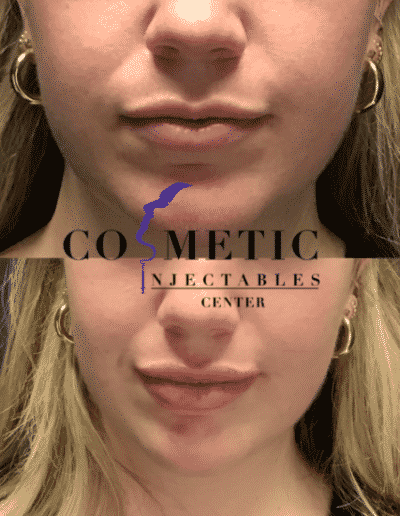 Before And After Cosmetic Treatment Showing Changes In Facial Expression And Treatment Effects At A Cosmetic Injectables Center