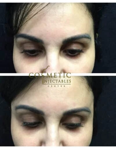 Before And After Photos Demonstrating The Transformation Of A Patient'S Forehead And Frown Lines After Cosmetic Treatment