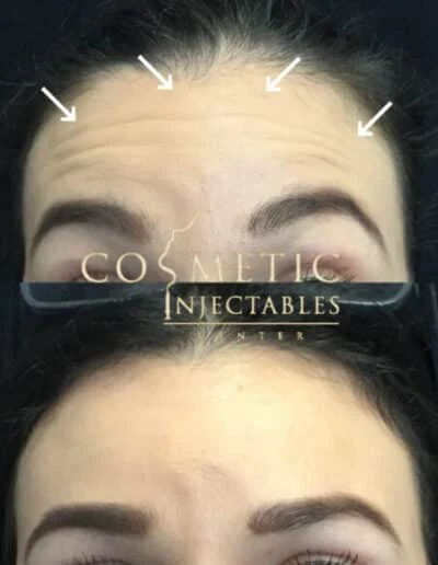 Before And After Results Of A Patient'S Forehead And Frown Line Reduction Treatment At Cosmetic Injectables Center