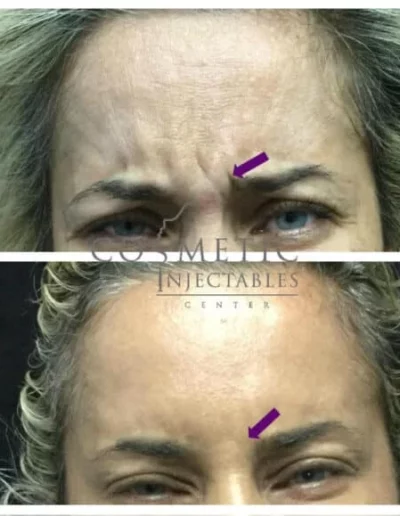 Before And After Close-Up Of A Patient'S Successful Forehead And Frown Lines Treatment At Cosmetic Injectables Center