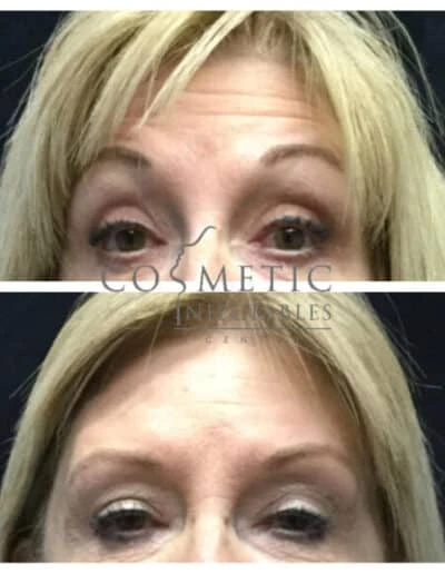 Comparison Of Forehead Appearance Before And After Cosmetic Rejuvenation Procedure