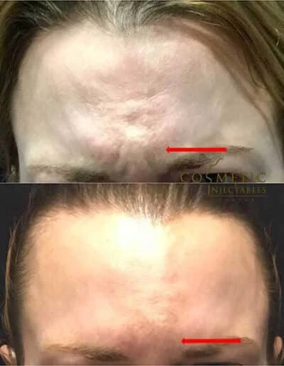 Dramatic Before And After Transformation Of Forehead Skin Smoothing Through Injectable Cosmetic Treatment