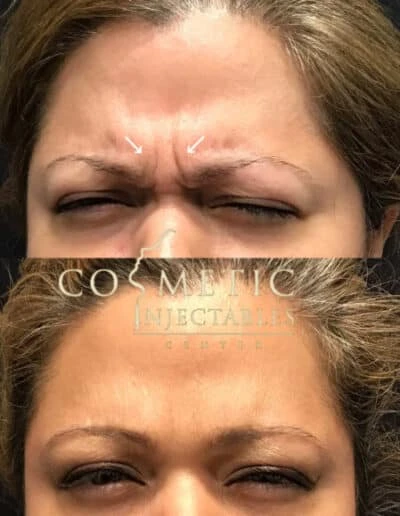 Before And After Visualization Of Forehead Wrinkle Reduction Through Specialized Injectable Treatment
