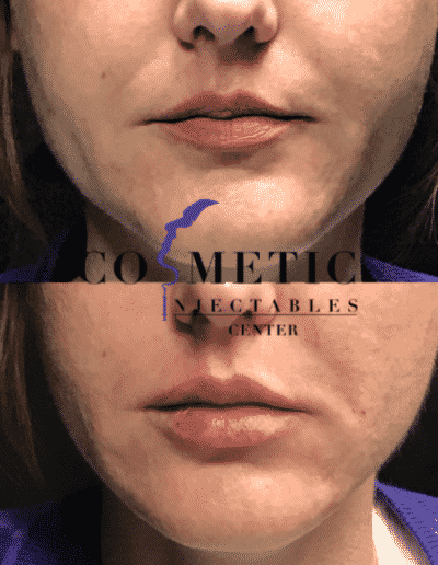 Frontal View Before And After Lip Enhancement Procedure, Showing Subtle Volume Increase And Contour Definition At A Cosmetic Injectables Center