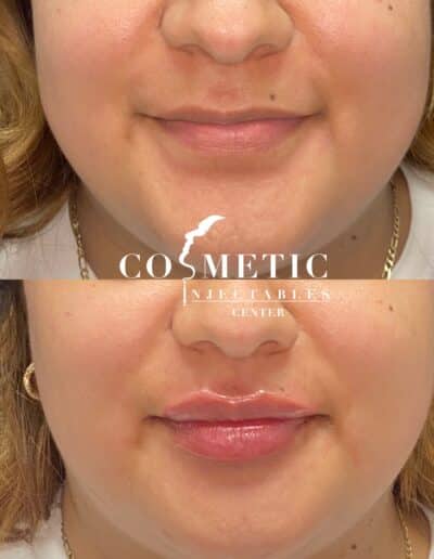Fuller Lips Enhancement Visible In Before And After Treatment Photos At A Cosmetic Injectables Center