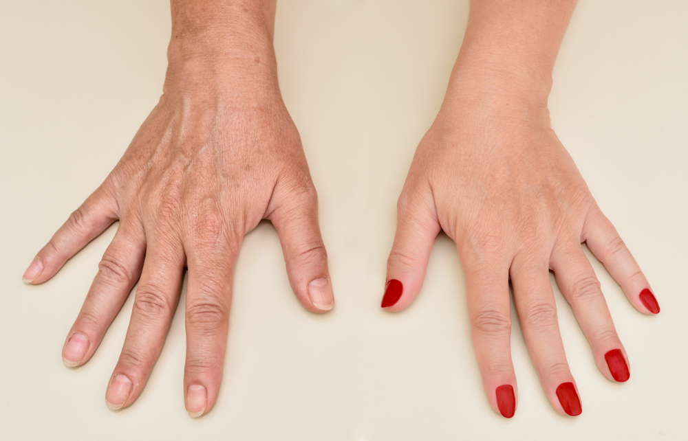 "Comparison of hands before and after cosmetic injectable procedure at Cosmetic Injectable Centre.