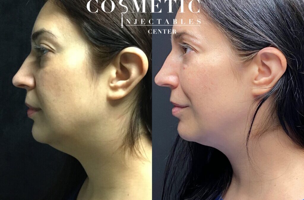 Kybella Double Chin Removal: Nonsurgical Submental Fat Reduction