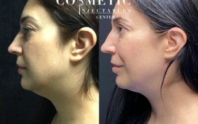 Kybella Double Chin Removal: Nonsurgical Submental Fat Reduction