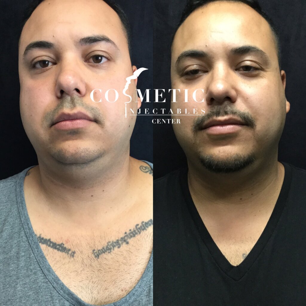 Male Patient Kybella Results After 6 Wees