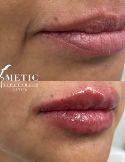 Before And After Comparison Of Lip Augmentation At A Cosmetic Injectable Center