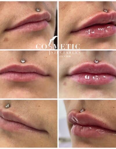 Before And After Views Of Lip Augmentation On Lips With Piercing At A Cosmetic Injectables Center