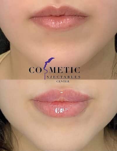 Before And After Photos Of A Lip Cosmetic Procedure, Illustrating The Enhancement After Treatment At A Cosmetic Injectables Center