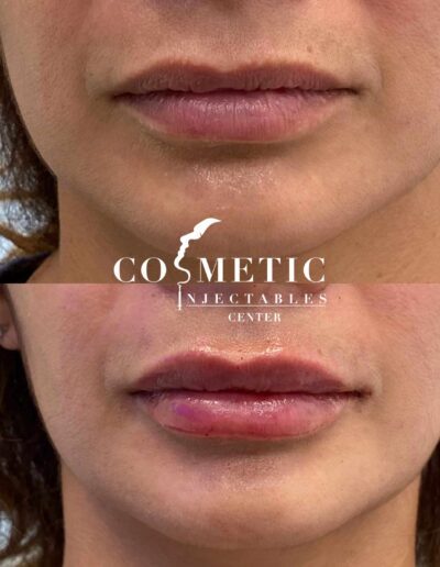 Before And After Lip Enhancement Procedure Showing Fuller Lips Post-Treatment.