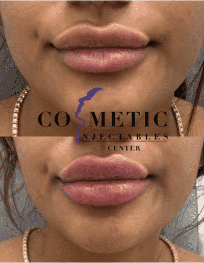 Close-Up Before And After Comparison Of Lip Enhancement Revealing Fuller Lips At A Cosmetic Injectables Center