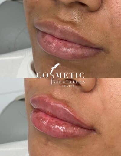 Close-Up Comparison Of Lip Enhancement Procedure Showing Natural And Post-Treatment Results At A Cosmetic Injectables Center
