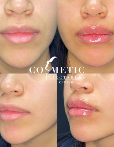 Four-Stage Lip Enhancement Results Showcasing Before And After Views At A Professional Cosmetic Injectable Center
