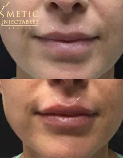 Before And After Lip Enhancement Showing The Planned Areas With Guide Marks At A Cosmetic Injectables Center