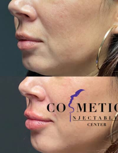 Profile View Of Lip Enhancement Before And After The Procedure, Demonstrating The Improved Shape And Volume At A Cosmetic Injectables Center
