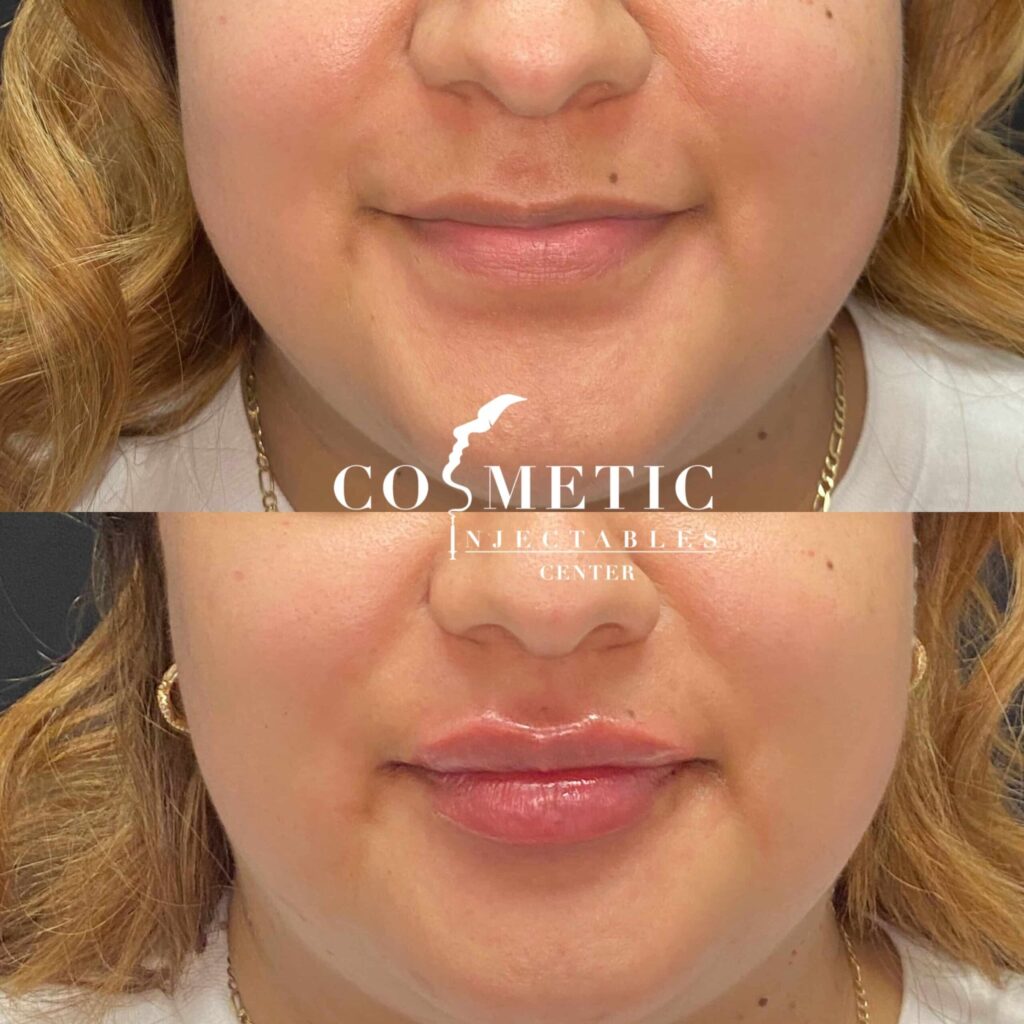 Before and after transformation with Restylane Kysse lip injections for enhanced volume and contour at a specialized cosmetic injectables center.