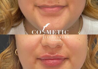 Before And After Transformation With Restylane Kysse Lip Injections For Enhanced Volume And Contour At A Specialized Cosmetic Injectables Center.