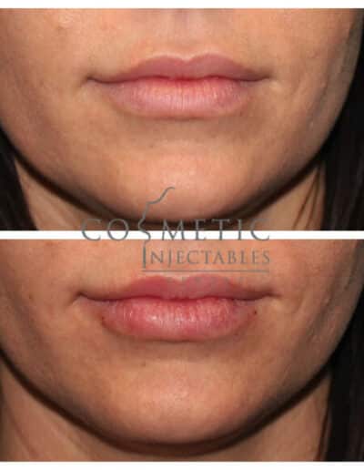 Visible Results Of Lip Enhancement Before And After The Procedure At A Cosmetic Injectables Center