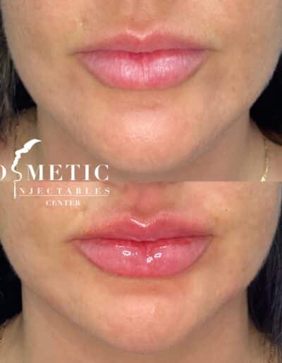 Before And After Results Of Lip Filler Enhancement At A Professional Cosmetic Injectables Center