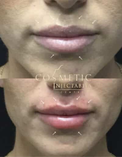 Before And After Comparison Of Lip Filler Procedure With Guide Marks On Patient'S Face At A Cosmetic Injectables Center
