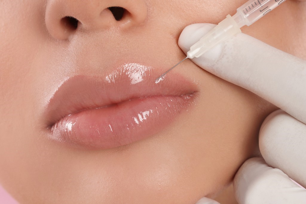 Injecting Lip Filler