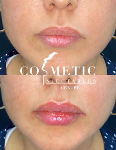 Before And After Comparison Of Lip Injection Treatment, Highlighting The Enhanced Volume At A Cosmetic Injectables Center