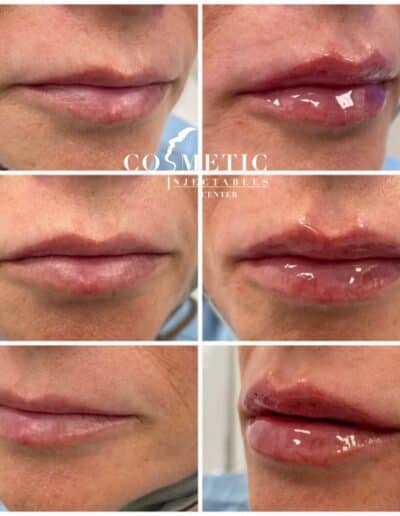 Before And After Comparison Of Lip Injections Showcasing Patient Results At A Cosmetic Injectables Center