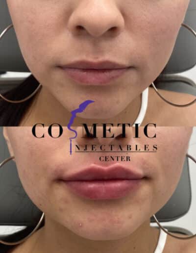 Before And After Images Of Lip Enhancement Procedure, Showcasing Subtle Volume Increase At A Cosmetic Injectables Center