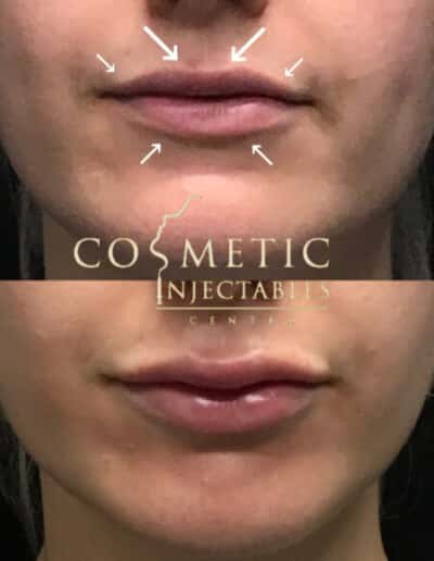 Before And After Lip Procedure With Directional Guide Marks, Detailing Treatment Approach At A Cosmetic Injectables Center