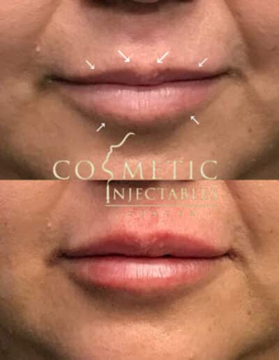 Before And After Results Of A Detailed Lip Procedure With Visible Guide Marks At A Cosmetic Injectables Center