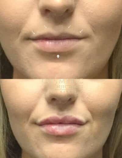 Before And After Lip Procedure With Surgical Guide Marks Indicating Treatment Areas At A Cosmetic Injectables Center