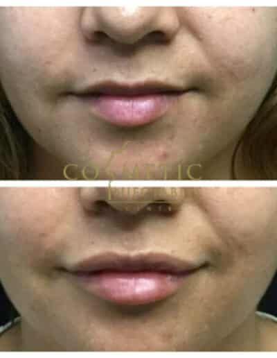 Before And After Images Of A Lip Treatment Showcasing Enhanced Fullness And Symmetry At A Cosmetic Injectables Center