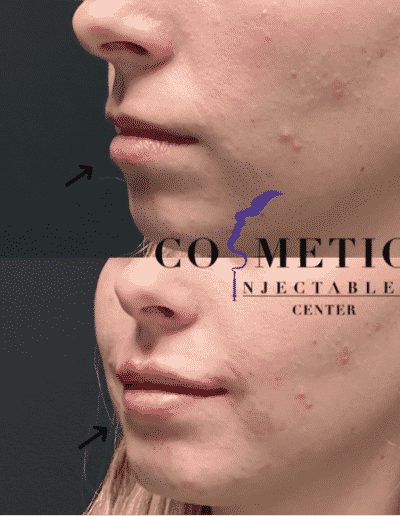 Side Profile Comparison Of Lip Treatment Before And After, With Arrows Highlighting The Enhanced Lip Area At A Cosmetic Injectables Center