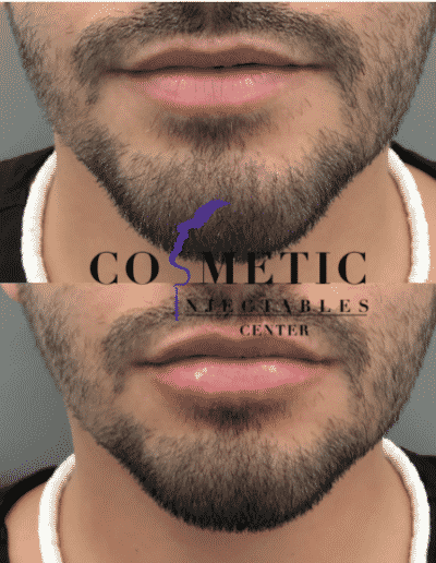 Before And After Comparison Of Male Lip Enhancement Showing Improved Contour At A Cosmetic Injectables Center