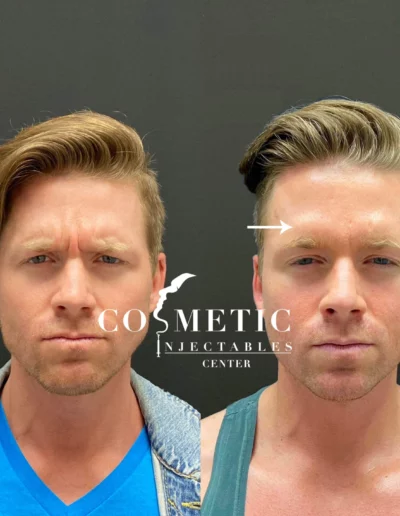 Male Patient Before And After Forehead And Frown Line Treatment At Cosmetic Injectable Center