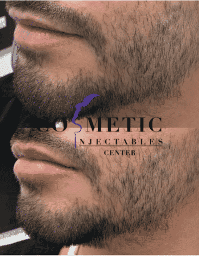 Close-Up Side Profile Of A Male Before And After A Cosmetic Procedure, Highlighting Facial Structure Enhancement At A Cosmetic Injectables Center