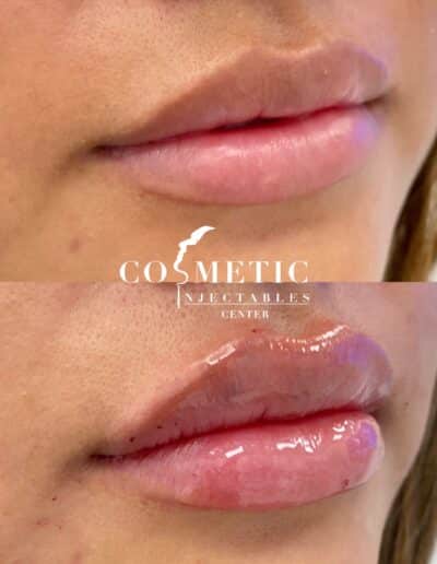 Natural Lip Filler Transformation Before And After Treatment At A Cosmetic Injectables Center